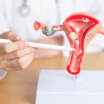 Working Women Are at Higher Risk for Uterine Fibroids: Here's How to Prevent Them